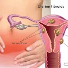 Maatskappy 1 beeld FIBROID TREATMENT CLINIC AFRICA Uterine Fibroids in Cape Town WC