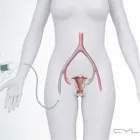 Maatskappy 5 beeld FIBROID TREATMENT CLINIC AFRICA Uterine Fibroids in Cape Town WC